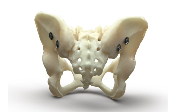 University of Utah receives first ever FDA approval for new bone repair device - Vimarsana News