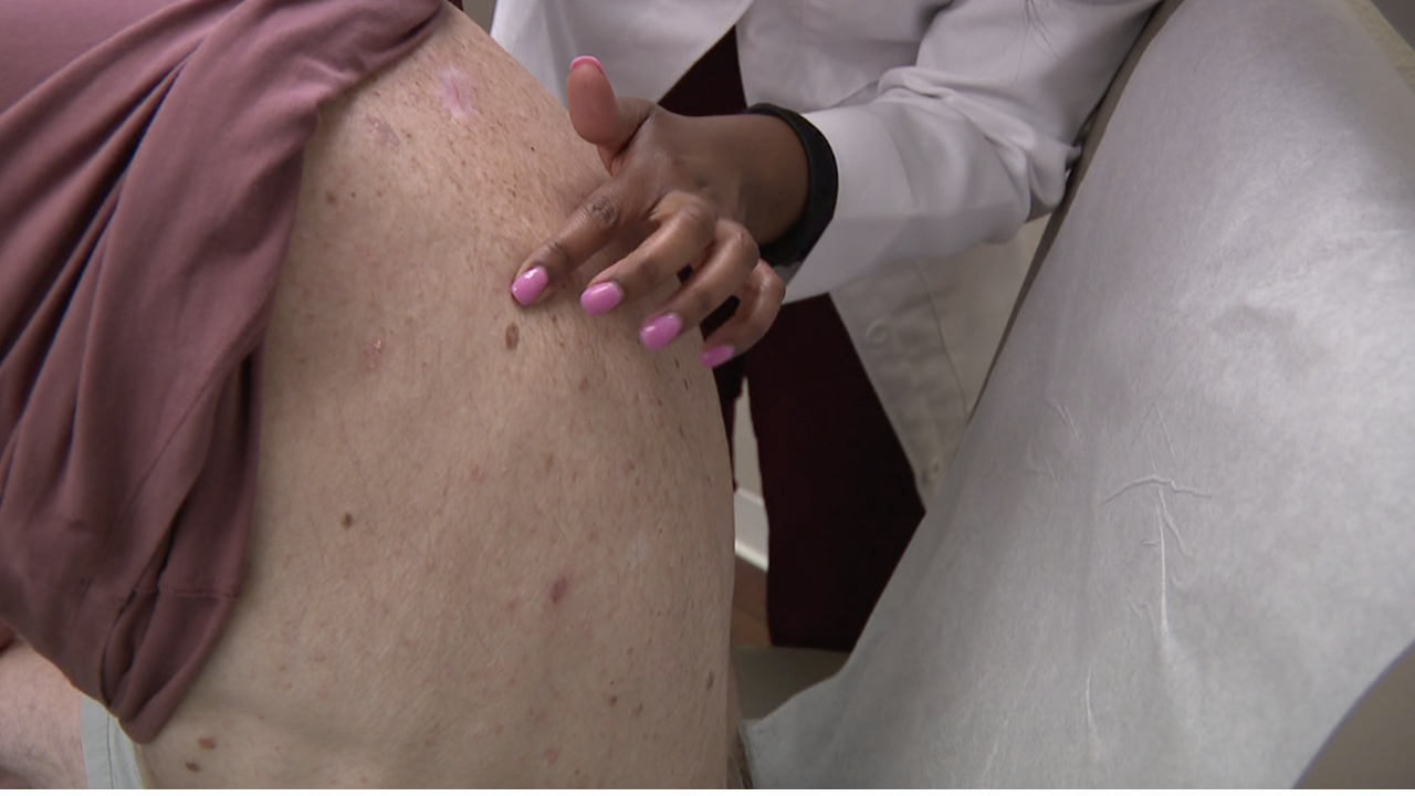 Dermatologists raise awareness for Melanoma Monday, free screenings available - Vimarsana News